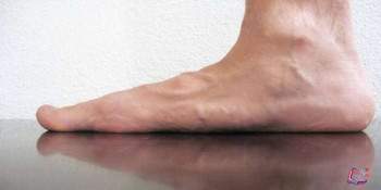 Mpeg القدم المسطحة فلات فوت Flatfeet